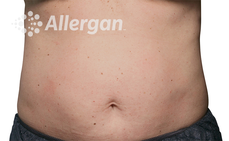 abdomen3