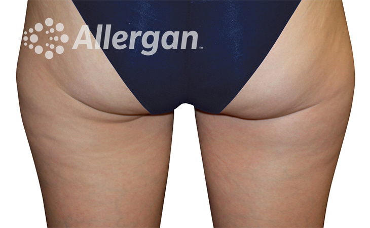 CoolSculpting-Female thigh image 5_Desk